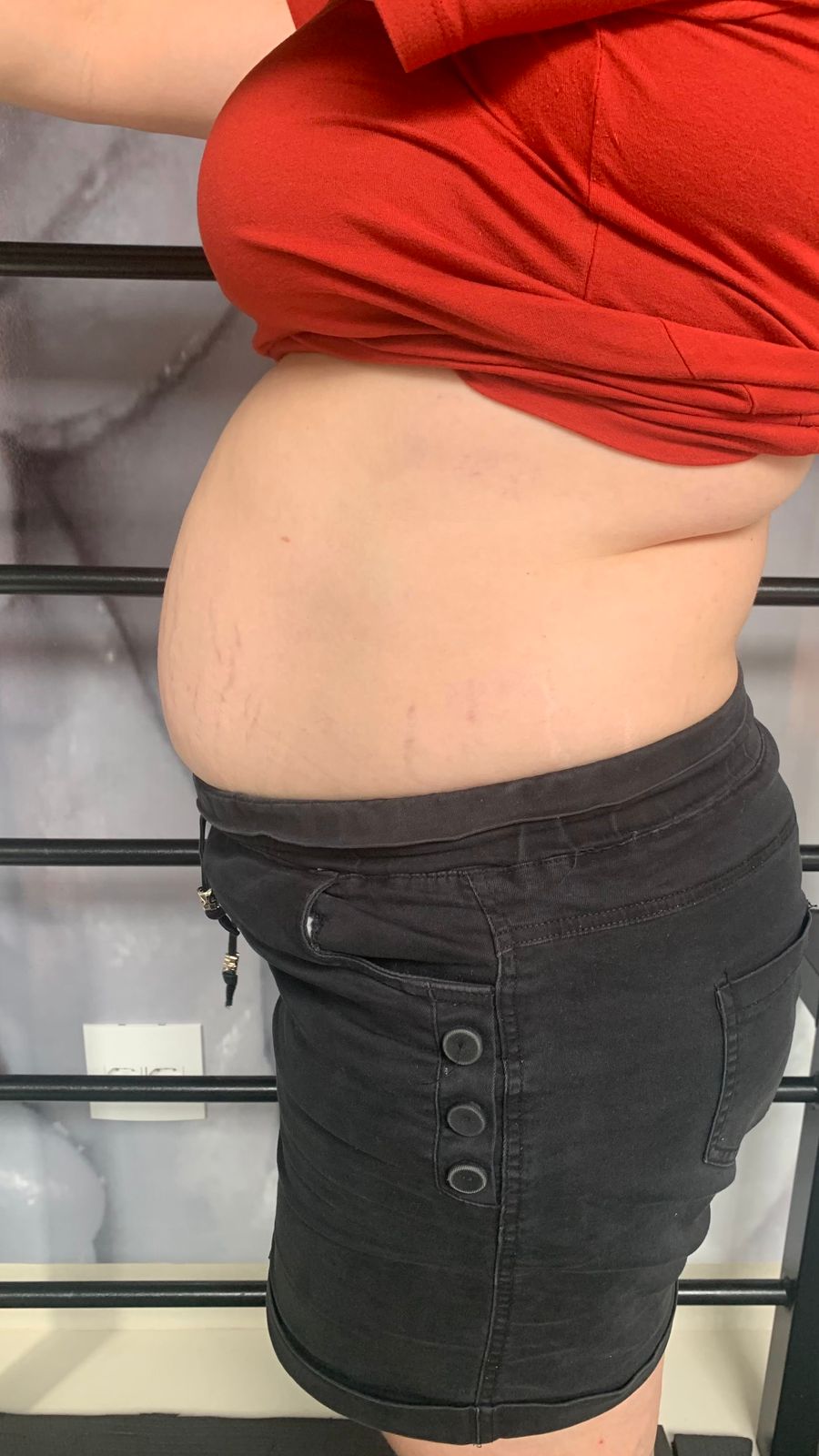 Antes e depois Ana Rafaela
